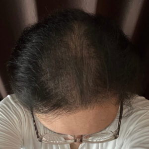 薄毛改善の検証実験開始より11ヶ月経過後　頭頂部状態　画像